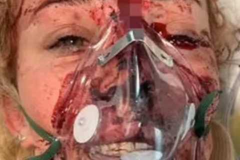 Teen Motocross Rider Escapes Death After Shattering Face in Horror Crash